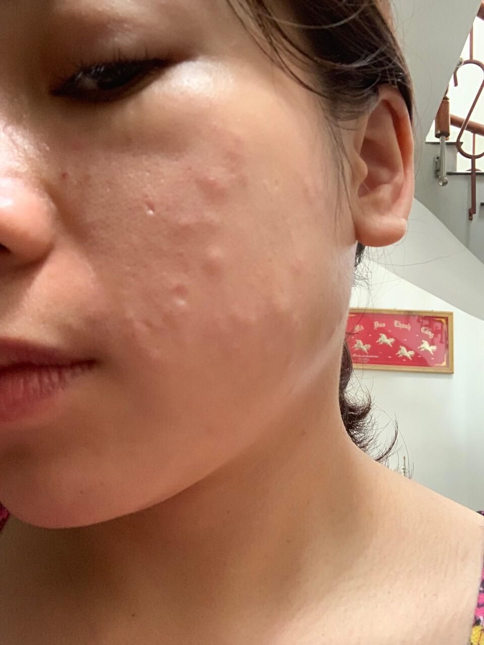 3 days after treatment with wrong needle on left side